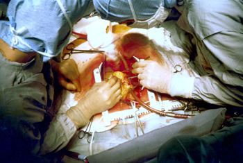 Coronary artery bypass surgery by Jerry Hecht